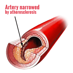 Artery narrowed by atherosclerosis
