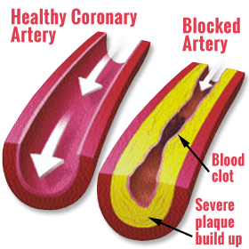 Healthy Coronary Artery vs. Blocked Artery (Blood clot, Severe plaque build up)