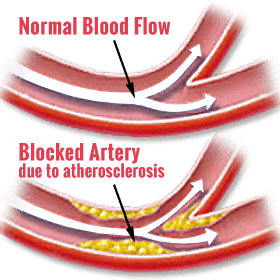 Normal Blood Flow vs. Blocked Artery due to atherosclerosis